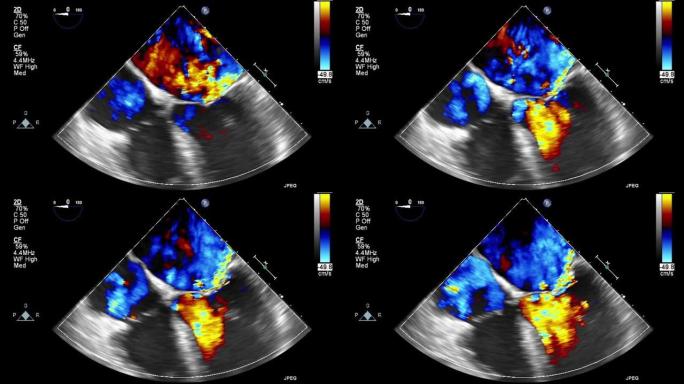 高质量视频超声经食管心脏检查。