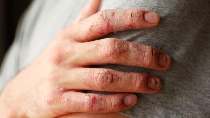 患有牛皮癣和湿疹的男人的手指。皮肤脱皮的特写