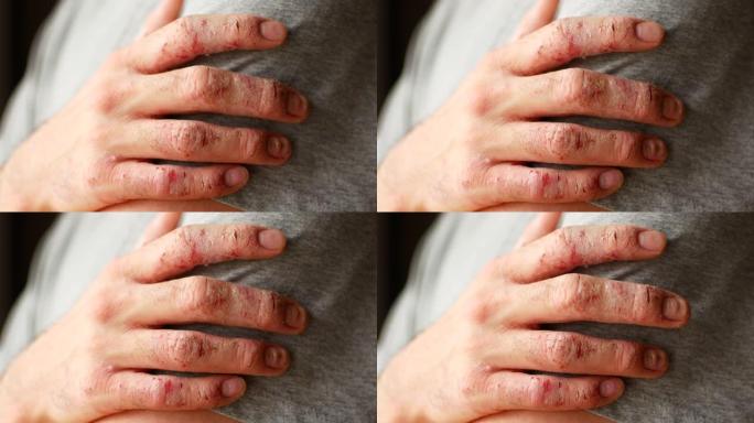 患有牛皮癣和湿疹的男人的手指。皮肤脱皮的特写