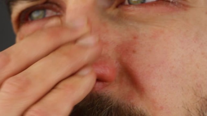 男子抓鼻子有红色过敏反应，面部皮肤红肿脱皮牛皮癣，季节性皮肤科问题，侧视特写宏观