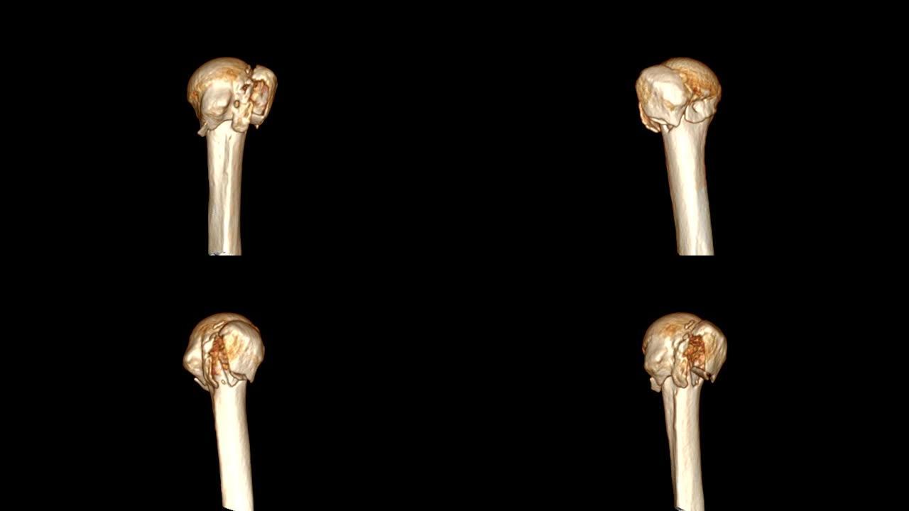 CT肱骨3D渲染图像在屏幕上显示肱骨骨折头。