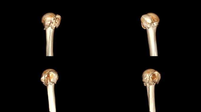 CT肱骨3D渲染图像在屏幕上显示肱骨骨折头。