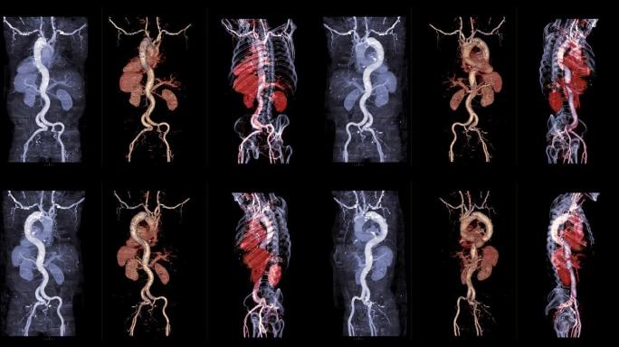 比较CTA全主动脉Mip图像3D渲染图像和3D和骨图像在显示主动脉夹层的屏幕上的翻转。