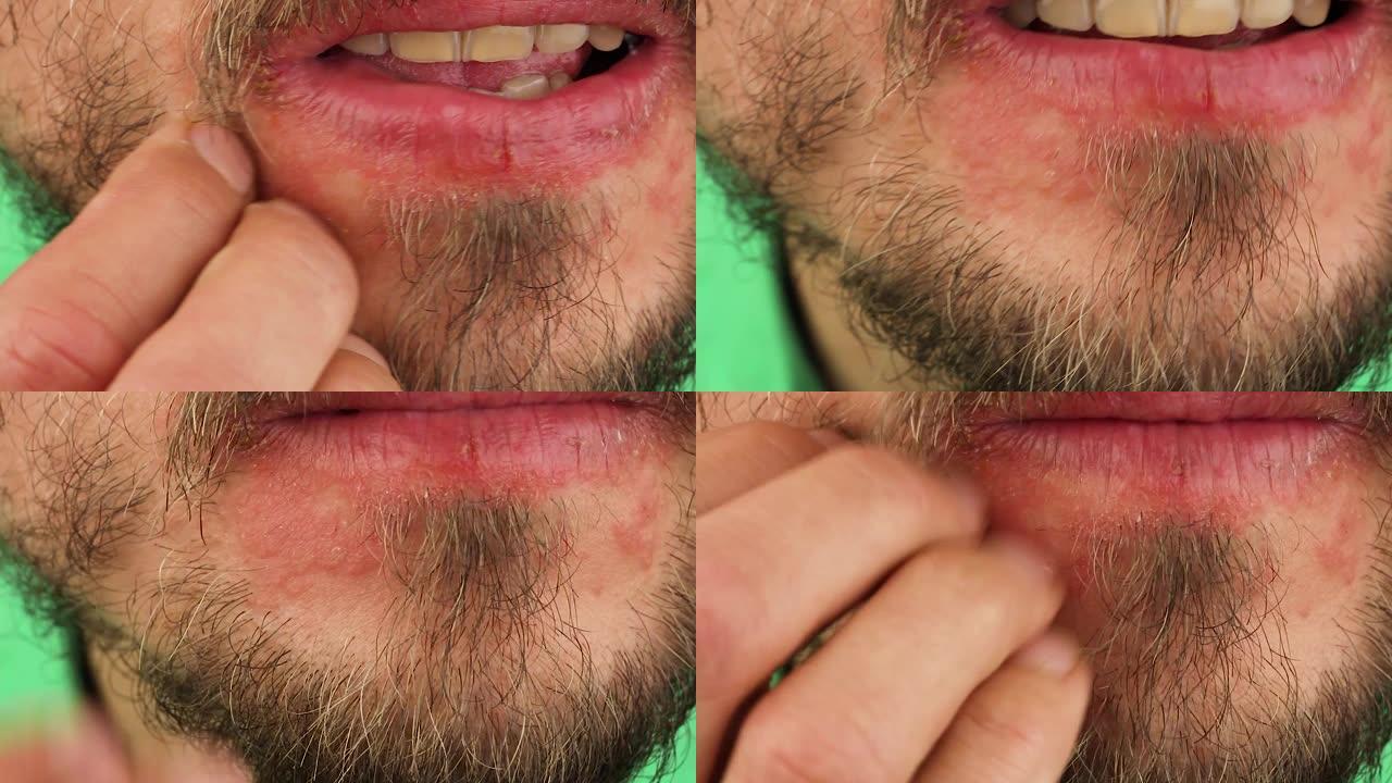 人类抓挠下巴过敏反应，嘴唇附近面部皮肤红肿脱皮牛皮癣，季节性皮肤病学问题，特写宏观