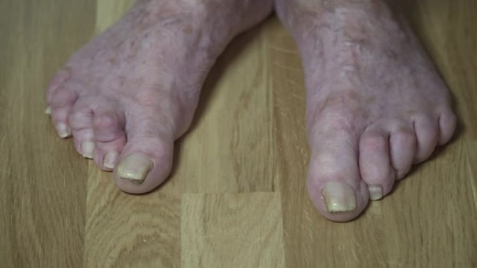 老生病的女性脚的特写镜头，脚趾弯曲，指甲长吓人。老年妇女脚赤裸，脚趾酸痛。一个老年养老金领取者的大的