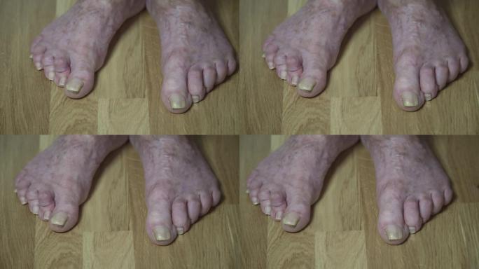 老生病的女性脚的特写镜头，脚趾弯曲，指甲长吓人。老年妇女脚赤裸，脚趾酸痛。一个老年养老金领取者的大的