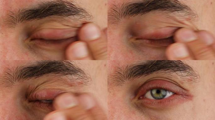 人类抓伤左眼有红色过敏反应和眨眼，面部皮肤红肿和脱皮牛皮癣，季节性皮肤病学问题，特写宏观