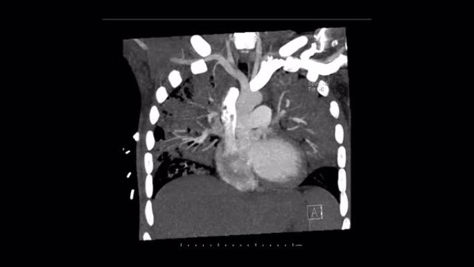 冠状面肺动脉计算机断层扫描诊断肺栓塞