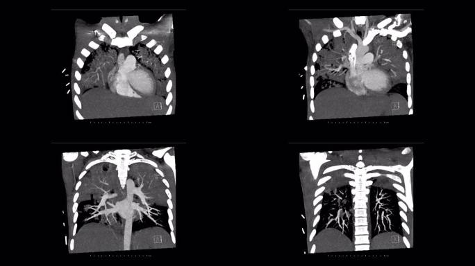 冠状面肺动脉计算机断层扫描诊断肺栓塞