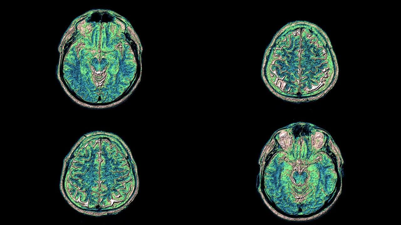 对大脑和头部进行大量彩色MRI扫描，以检测肿瘤。诊断医疗工具