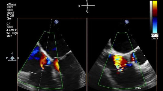 高质量视频超声经食管心脏检查。