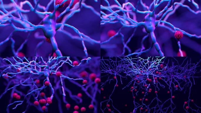 新型冠状病毒肺炎如何损害大脑，髓磷脂的恶化是保护神经元的脂肪涂层