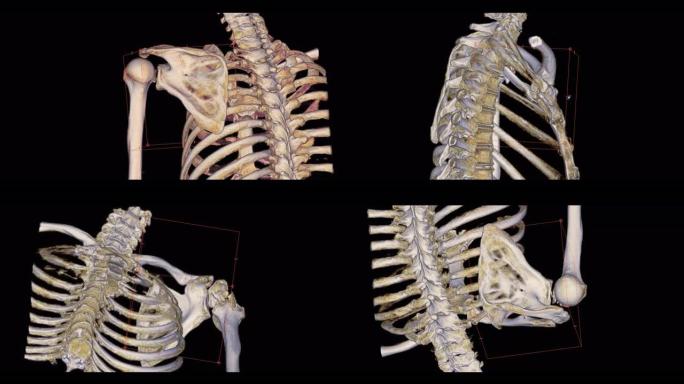 左肩ct扫描三维渲染显示肱骨头骨折。