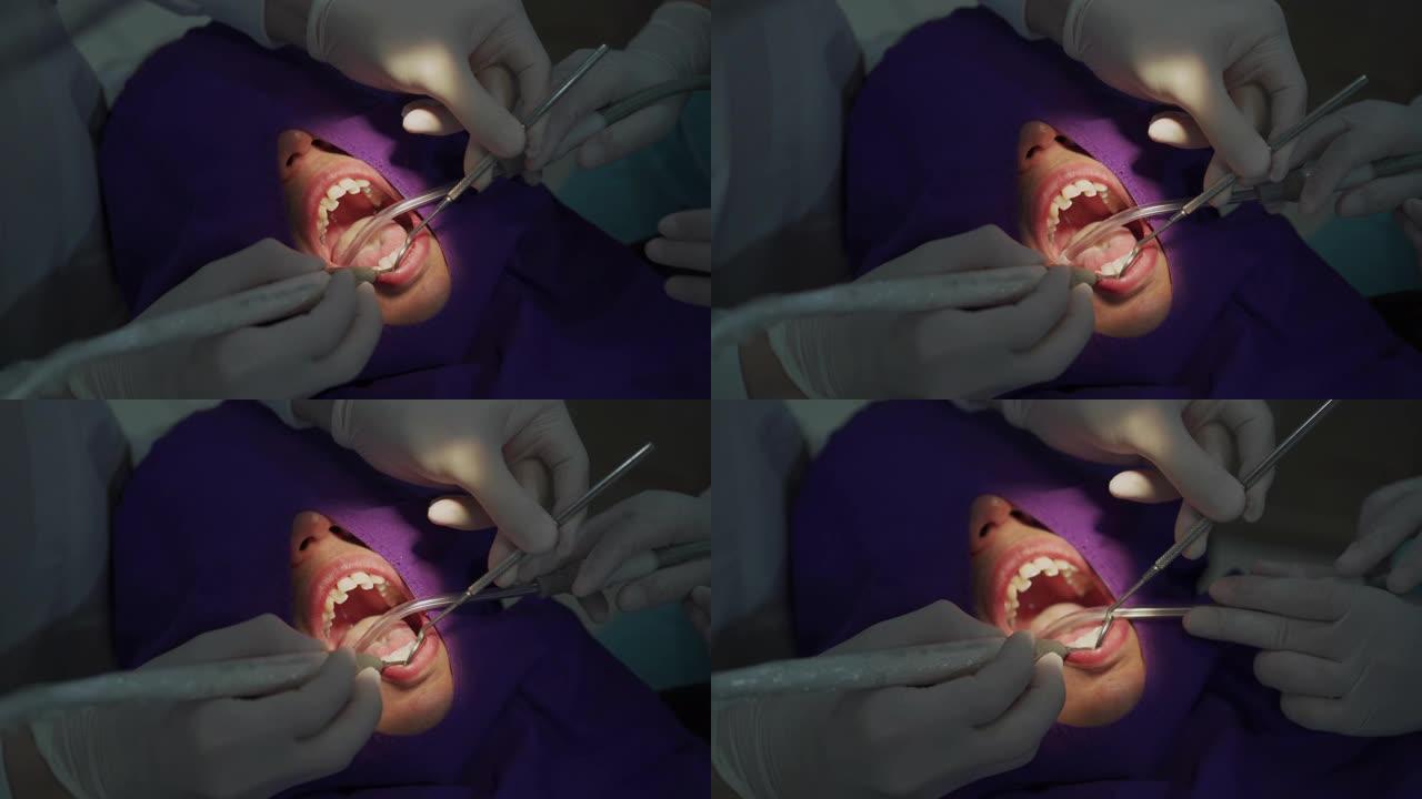 牙医在男人的嘴上清洁牙垢 (牙结石)