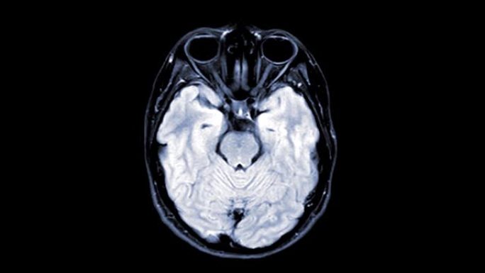 脑轴t2 flair的MRI用于检测脑中风疾病。