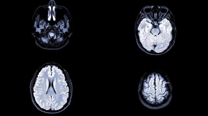 脑轴t2 flair的MRI用于检测脑中风疾病。