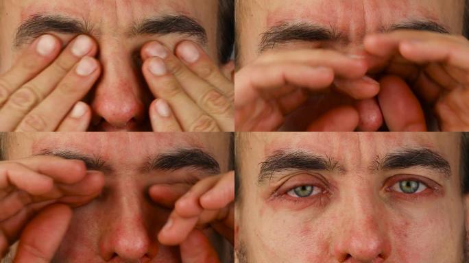 男人眨眼有红色过敏反应和划痕，面部皮肤红肿和脱皮牛皮癣，季节性皮肤病学问题，特写