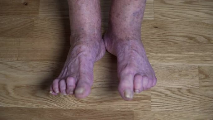 生病的老腿。高级腿部问题。指甲残缺的老妇人。老年女性脚趾上的趾甲真菌特写。蓬头垢面的crone脚趾甲