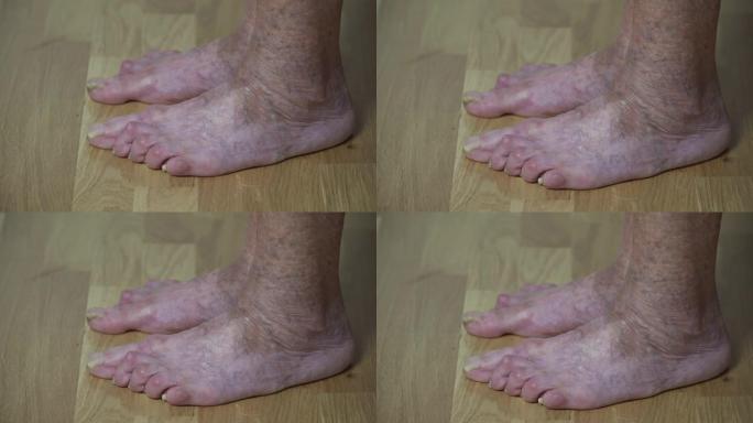 生病的老腿。高级腿部问题。指甲残缺的老妇人。老年女性脚趾上的趾甲真菌特写。蓬头垢面的crone脚趾甲