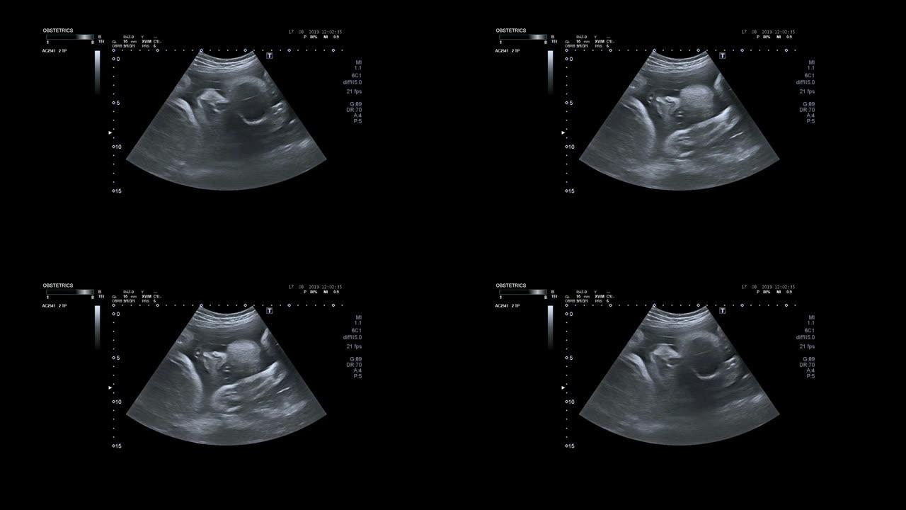 孕妇超声检查。婴儿身体和脊柱的超声波。小婴儿正在母亲的肚子里翻身。32周的生命。母亲子宫中的婴儿在超