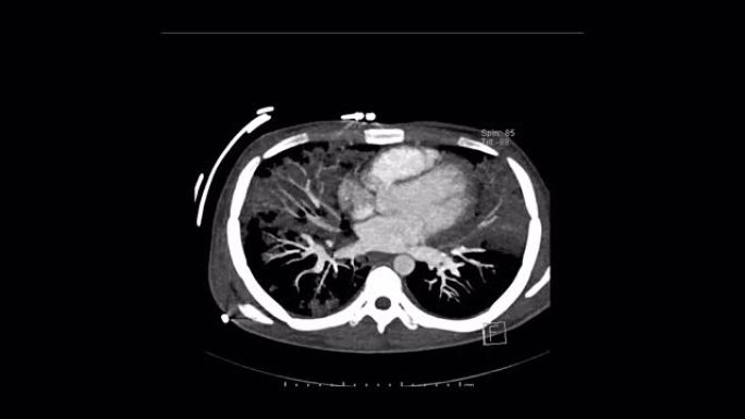 轴向肺动脉计算机断层扫描诊断肺栓塞