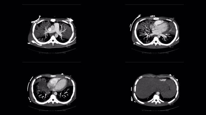 轴向肺动脉计算机断层扫描诊断肺栓塞