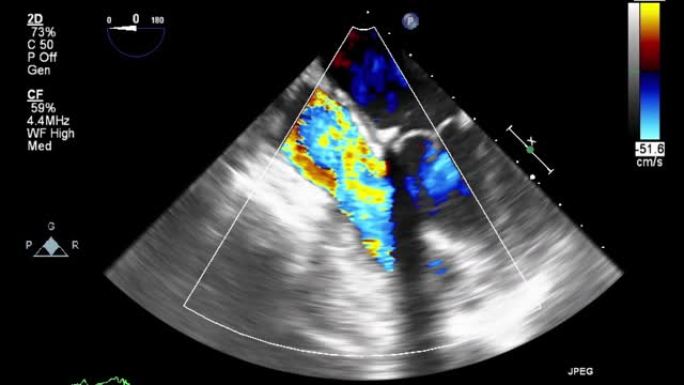 高质量视频超声经食管心脏检查。