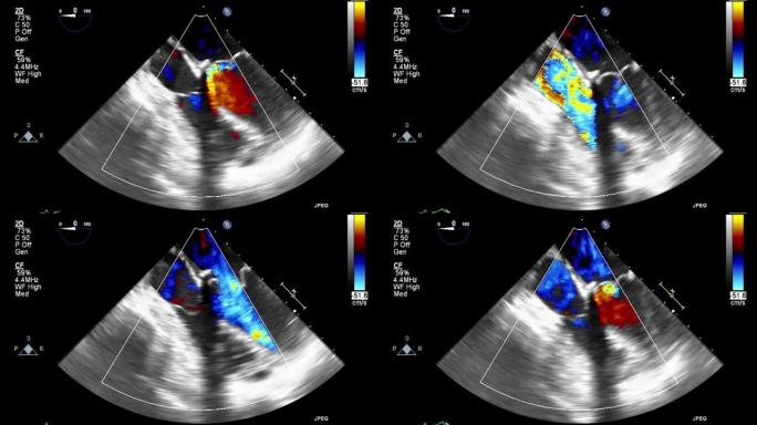 高质量视频超声经食管心脏检查。