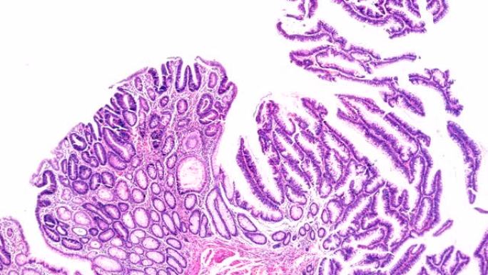 肠道腺瘤病人显微镜下病理标本