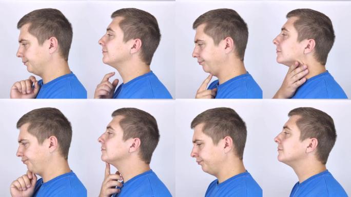 人类第二次抬起下巴。整形手术、心理成形术或面部建筑前后的照片。下巴脂肪去除和面部轮廓校正