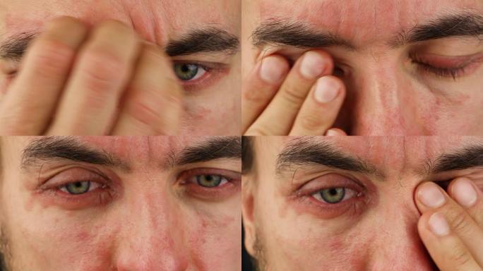 人体抓伤额头和眼睛有红色过敏反应，面部皮肤红肿脱皮银屑病，季节性皮肤科问题，特写宏观