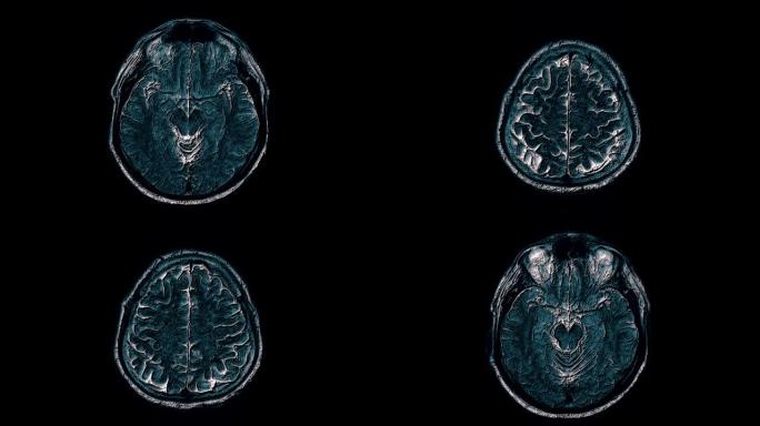 对大脑和头部进行大量彩色MRI扫描以检测肿瘤。诊断医疗工具