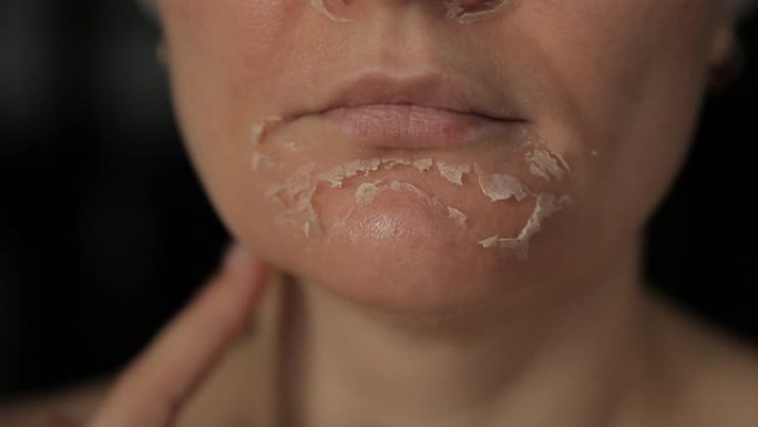 维甲酸面部脱皮。化学脱皮后女人的脸。脸上片状皮肤