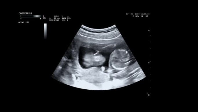孕妇超声检查。婴儿身体和脊柱的超声波。小婴儿正在母亲的肚子里翻身。16周的生命。母亲子宫中的婴儿在超