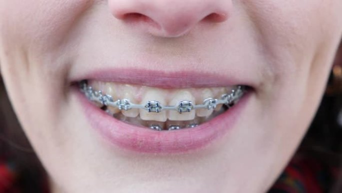 牙齿上戴着牙套的年轻女孩看着相机微笑。特写。牙齿很脏