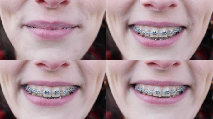 牙齿上戴着牙套的年轻女孩看着相机微笑。特写。牙齿很脏