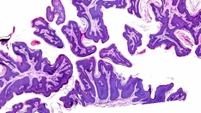 显微镜下皮肤乳头状瘤病理标本