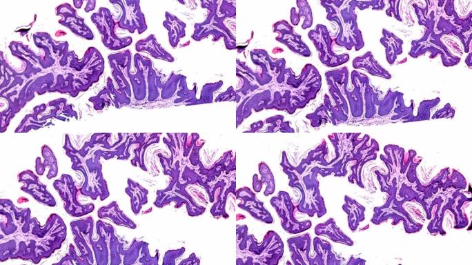 显微镜下皮肤乳头状瘤病理标本