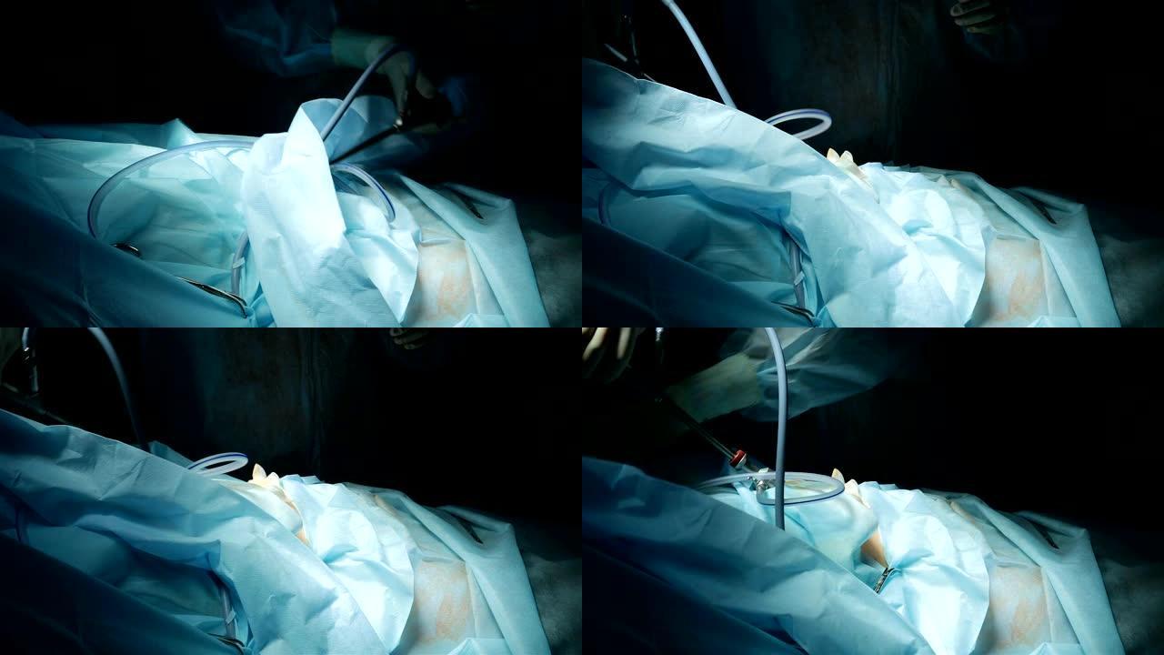 用于腹腔镜检查的手术器械安装在患者的腹腔中。