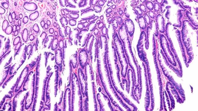 肠道腺瘤病人显微镜下病理标本