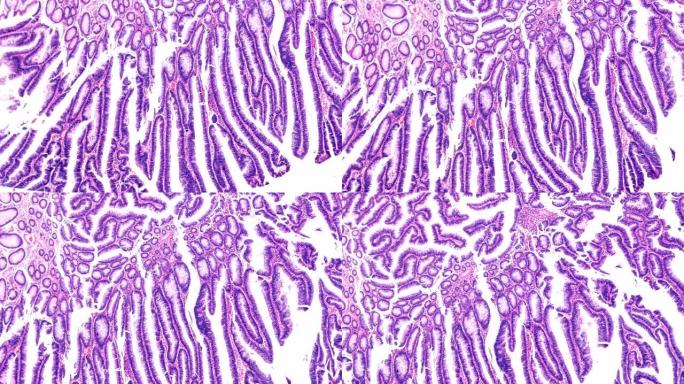 肠道腺瘤病人显微镜下病理标本