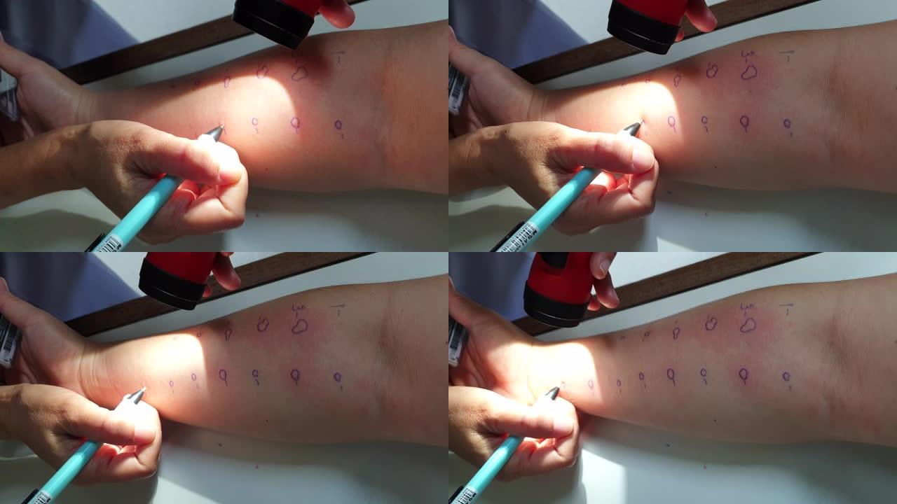 医用皮肤点刺试验用于过敏气雾剂试验皮疹反应
