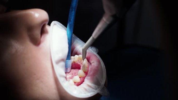 正畸医生的年轻女牙医招待会更换牙套抛光凝胶粘合