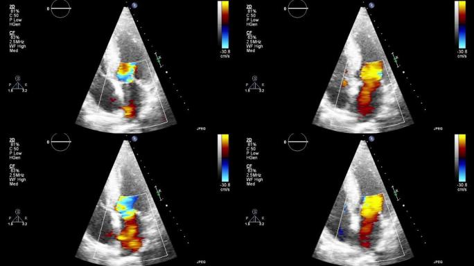 高质量视频超声经食管心脏检查。