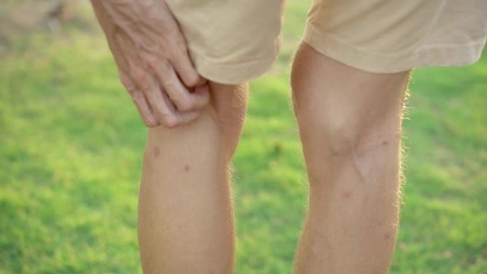 一名男子在自然背景下拍摄的慢动作划伤了被蚊子严重叮咬的双腿。咬昆虫概念