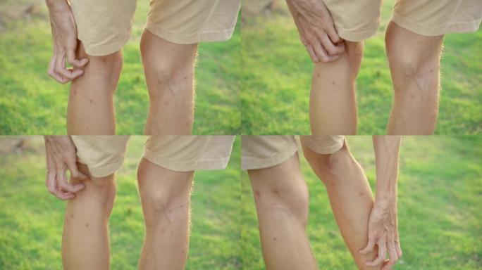 一名男子在自然背景下拍摄的慢动作划伤了被蚊子严重叮咬的双腿。咬昆虫概念