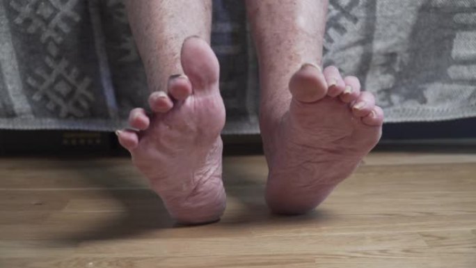 脚趾甲疼痛特写无法辨认的人，老人。一个可怜的女人的人脚长着未割的长指甲，看起来很恐怖。皱纹斑点腿高级