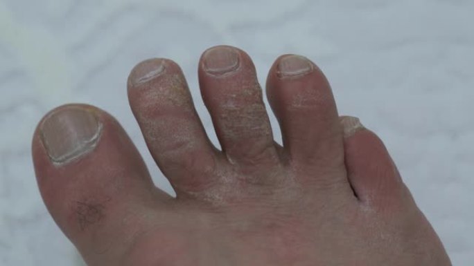 脚趾上形成的真菌和老茧，一种被忽视的人的脚，