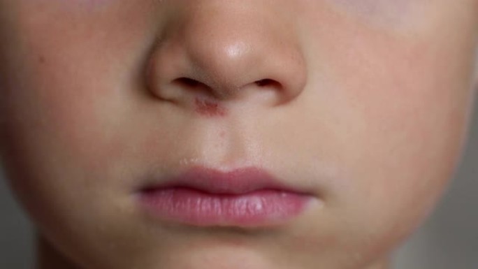 一个鼻子被划伤的小男孩的特写脸。4K。