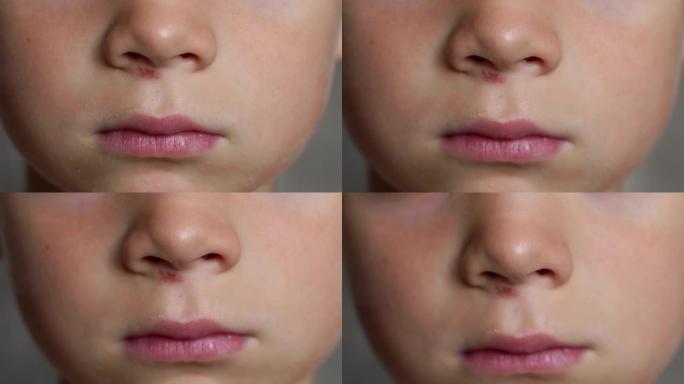 一个鼻子被划伤的小男孩的特写脸。4K。